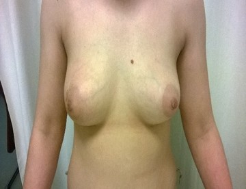 Αφαίρεση ινοαδενώματος διαμέτρου 3,5 εκ. από το δεξιό μαστό. 10 μέρες μετά το χειρουργείο